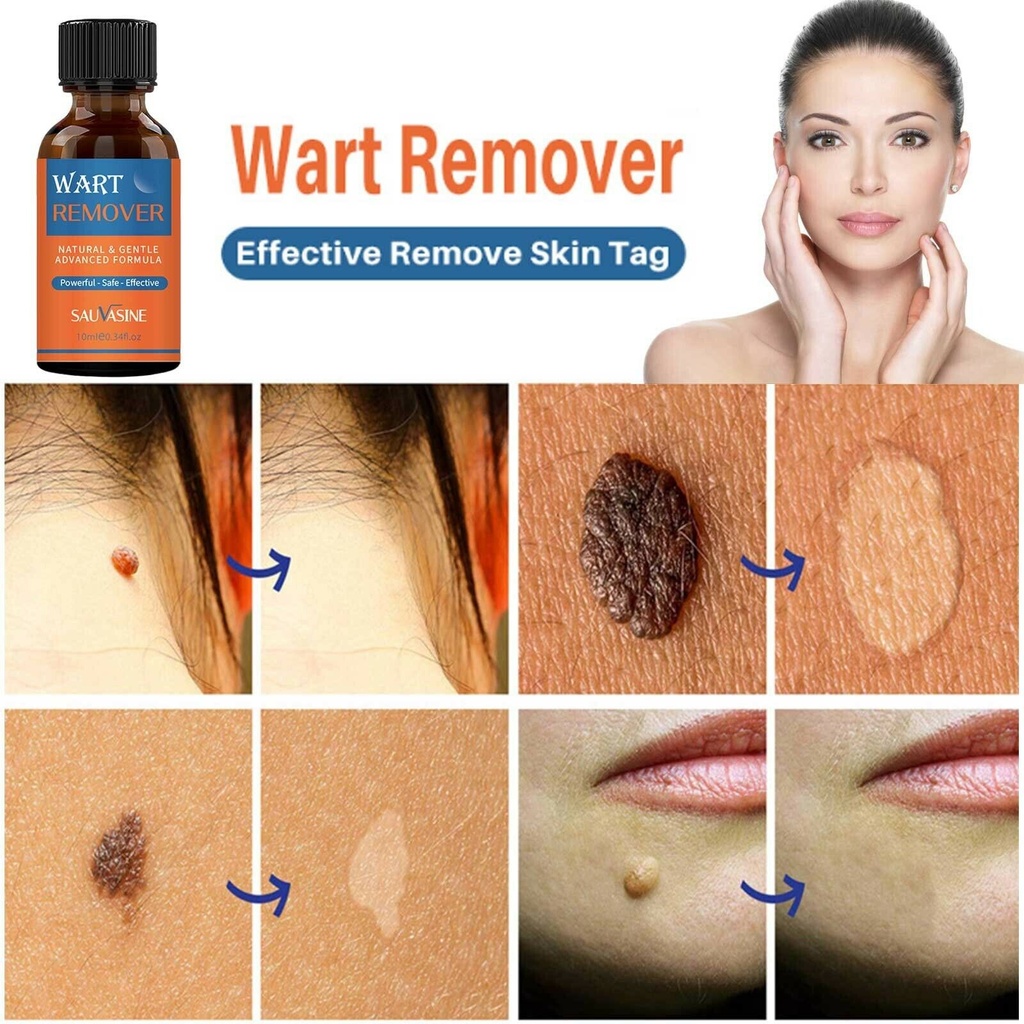 SAUVASINE WART REMOVER