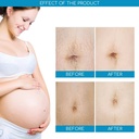 AICHUN BEAUTY ANTI-STRETCH MARK CREAM