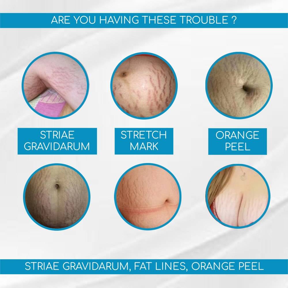 AICHUN BEAUTY ANTI-STRETCH MARK CREAM